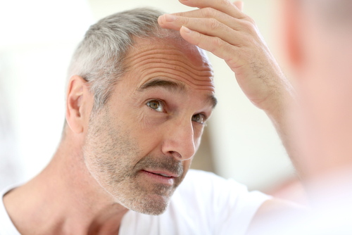 Ärftligt håravfall är utan tvekan den vanligaste typen av håravfall för både kvinnor och män men är betydligt mer vanligt hos män.  Foto: Shutterstock